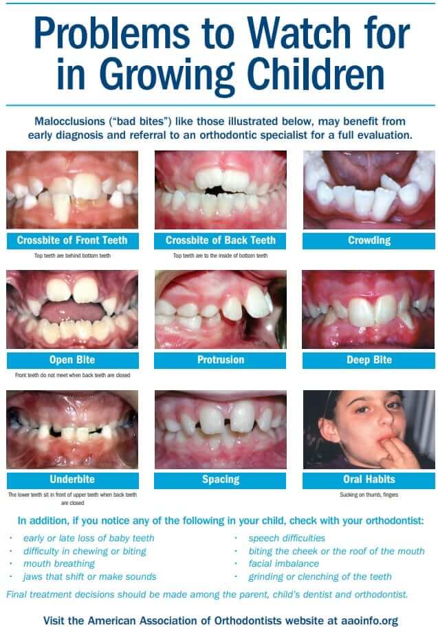 maxillary expansion treatment in orthodontics kids youth children child braces crossbite open bite overbite crowding ortho