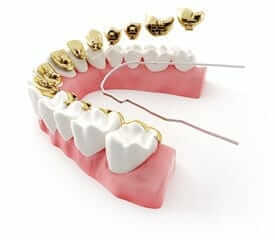 lingual braces orthodontist
