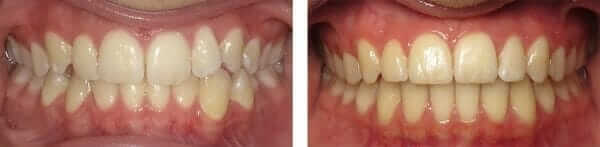 lingual braces