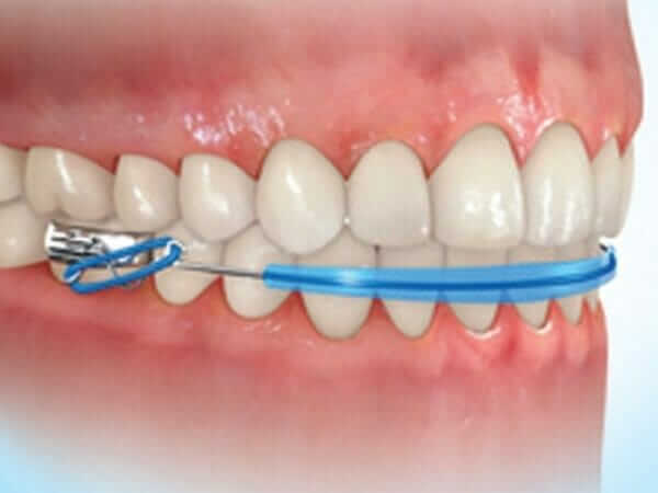 lip bumper orthodontic appliance