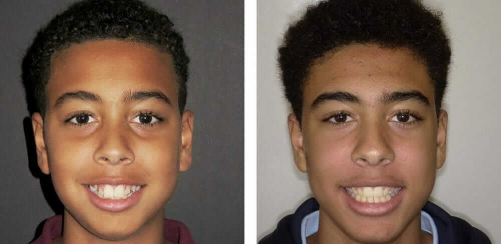 temecula child orthodontist