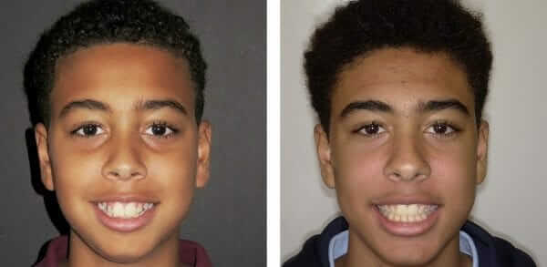 metal braces orthodontist