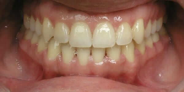 How Much are Metal Braces Cost