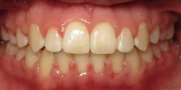 Metal Braces Vs Ceramic