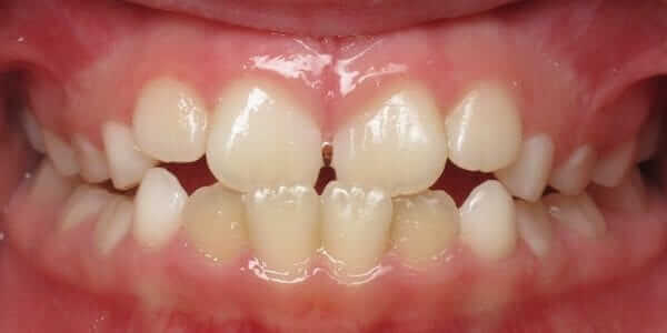 Crossbite Orthodontic Treatment is Required for this Child. Early Intervention for Children is Recommended by Dr. Ryan Redford and Dr. Burke. Crossbite Orthodontic Treatment is Required for this Child. Early Intervention for Children is Recommended by Dr. Ryan Redford and Dr. Burke.