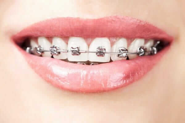 Metal Braces Self Ligating