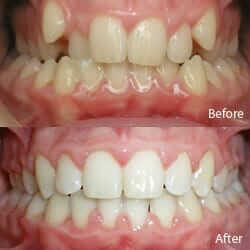 Narrow Jaws Before and After Orthodontic Treatment narrow jaws before and after orthodontic treatment