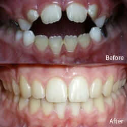open bites before and after picture