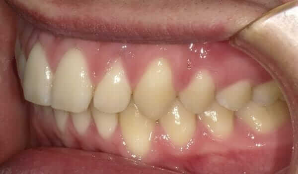 Overbite After Braces Treatment Overbite After Braces Treatment