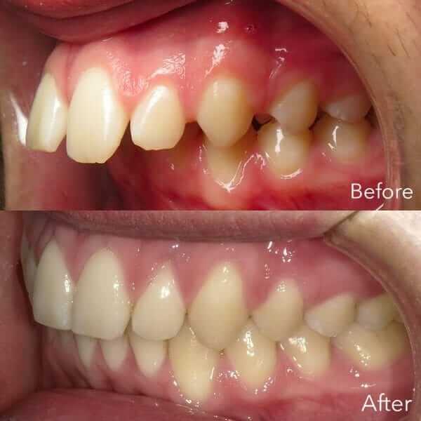 overbite before and after pictures overbite before and after pictures