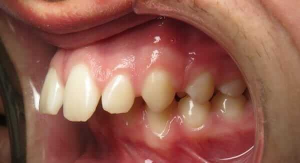 Malocclusion overbite overbite before pictures