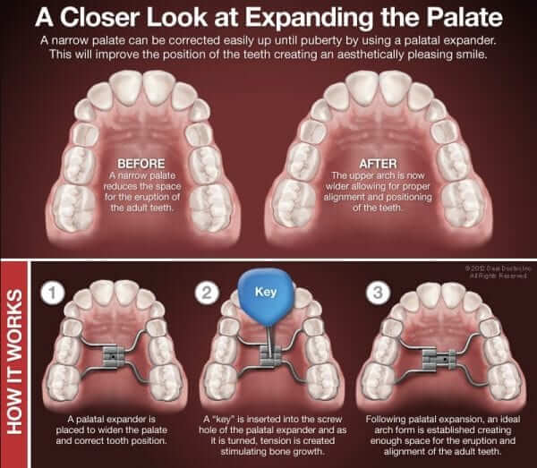 palatal expander