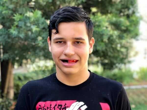 sports mouthguard for braces temecula