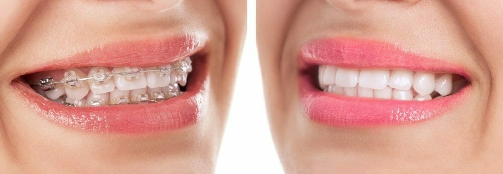 teeth whitening after braces teeth whitening after braces