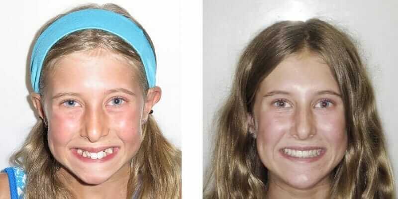 top orthodontist for children - kids braces - child braces before and after braces image top orthodontist for children - kids braces - child braces