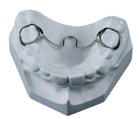 Transpalatal Arch Appliance