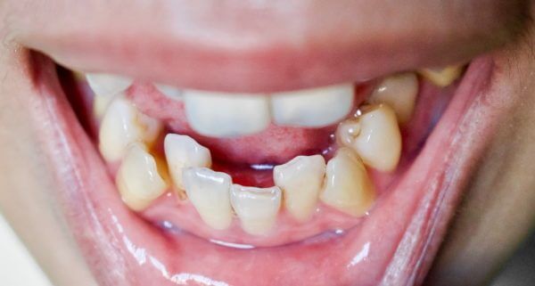 You can see the bottom teeth are beginning to grow into the other tooth's position in the jawbone. This requires orthodontic treatment.