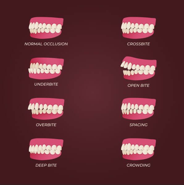 Types of Malocclusions - Bites Types of Malocclusions - Bites