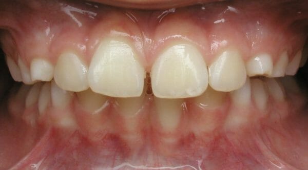 After Underbite Correction Reverse Pull Headgear Picture
