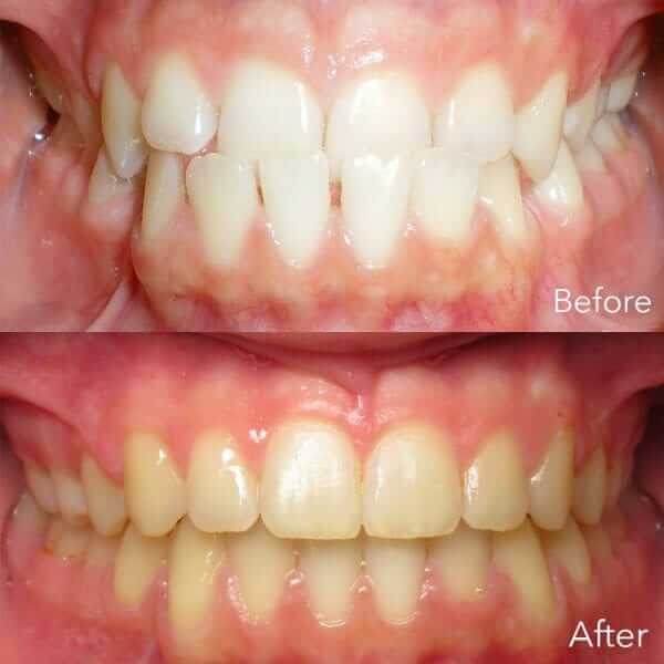 underbite before and after