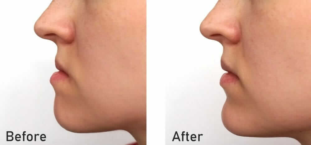 Underbite Before and After Treatment - Underbite vs. Overbite underbite before and after