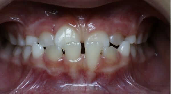 Before Underbite Correction Reverse Pull Headgear